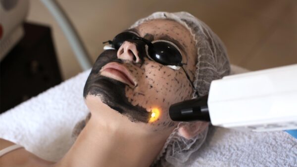 Laser Carbon Facial Treatment X 4
